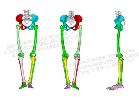 Эндопротезирование коленного сустава с&nbsp;применением 3D‑печати металлом